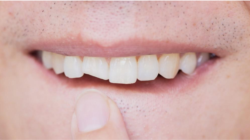 Broken Tooth