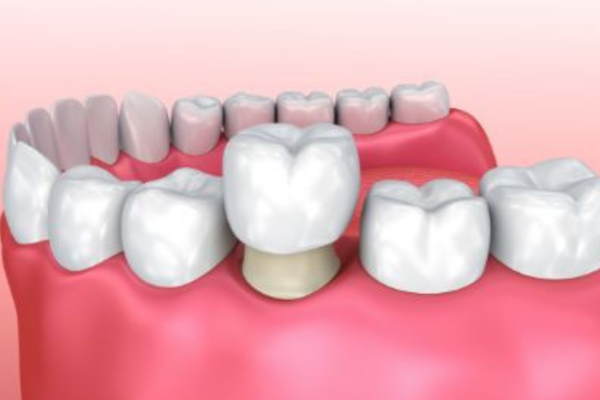 dental crowns