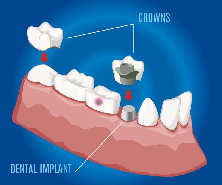 dental implant crowns