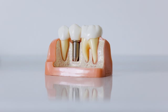 dental implant model