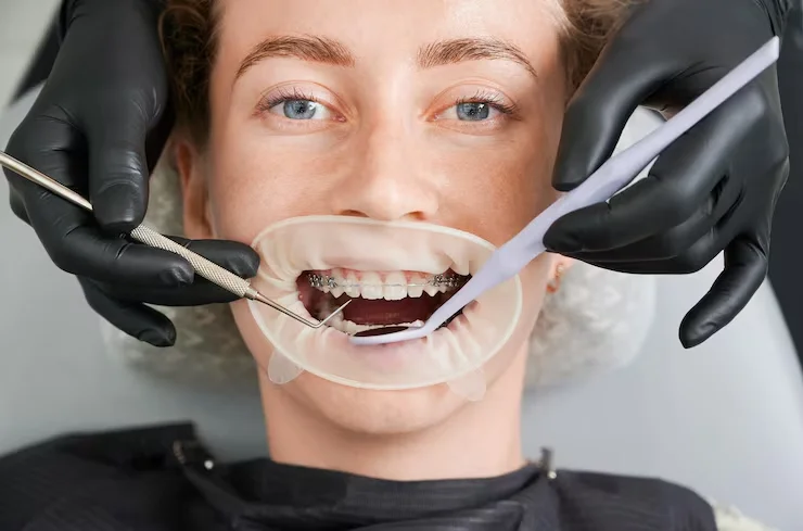 tooth sealants