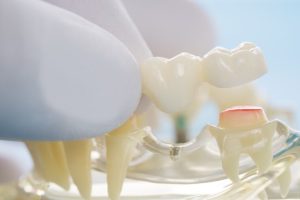 dental bridge vs implant