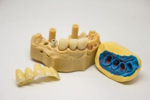 bridge dental procedure
