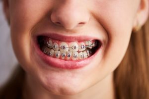 braces to invisalign