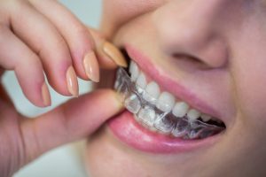 switching from braces to invisalign