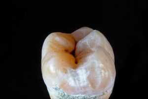cavity in wisdom tooth
