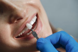 dental veneers for missing teeth