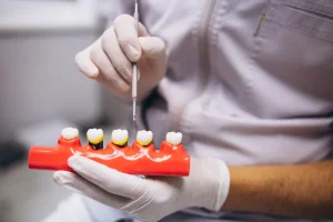bonded dental bridges