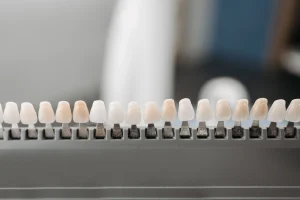 how long do veneers last